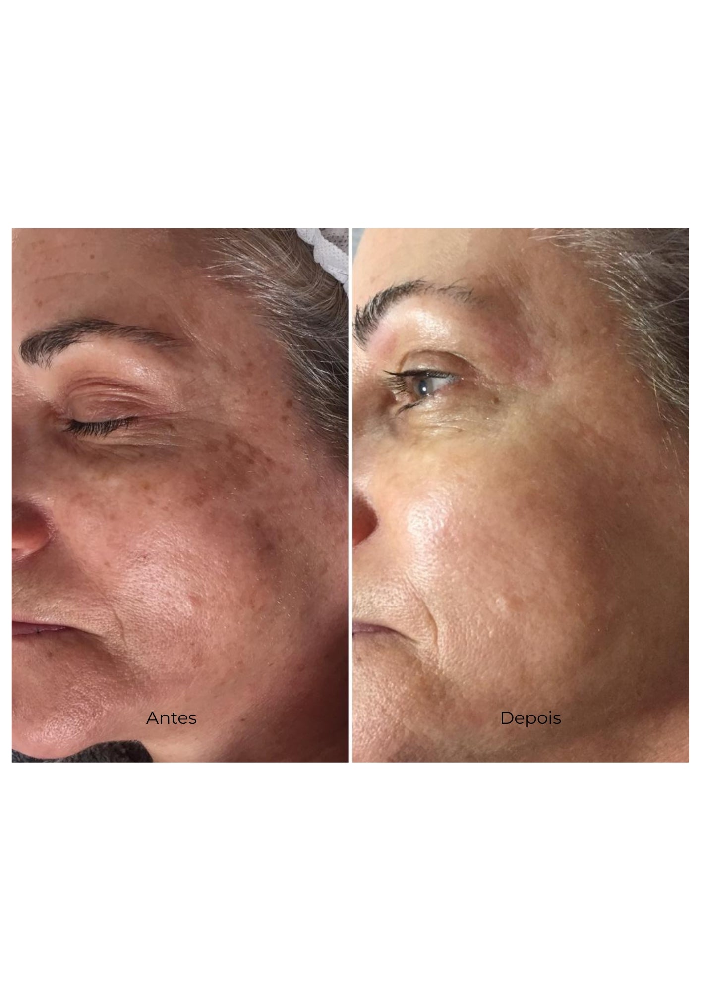 Protocolo Anti-Age Supreme - Rejuvenescimento Facial