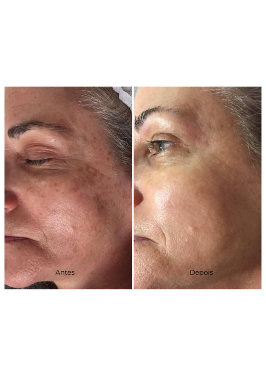 Protocolo Anti-Age Supreme - Rejuvenescimento Facial