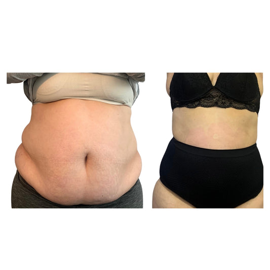 Protocolo Drena-Lifting - Emagrecimento e Flacidez Corporal