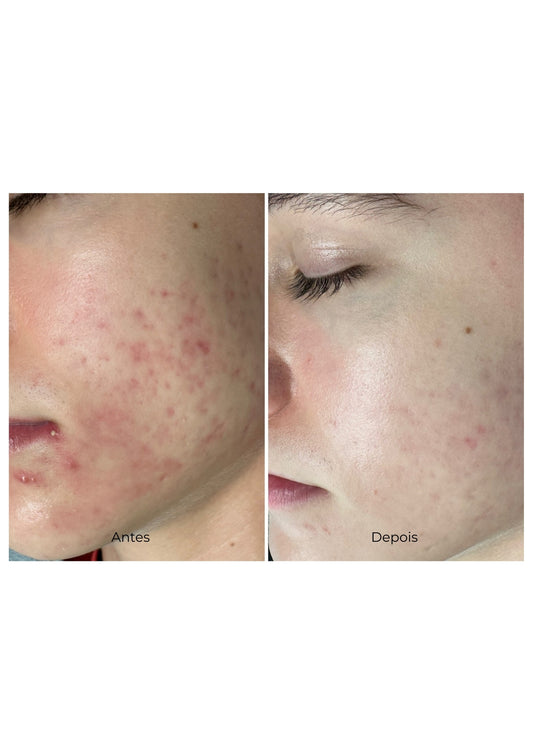Tratamento ANTI ACNE E Poros Dilatados