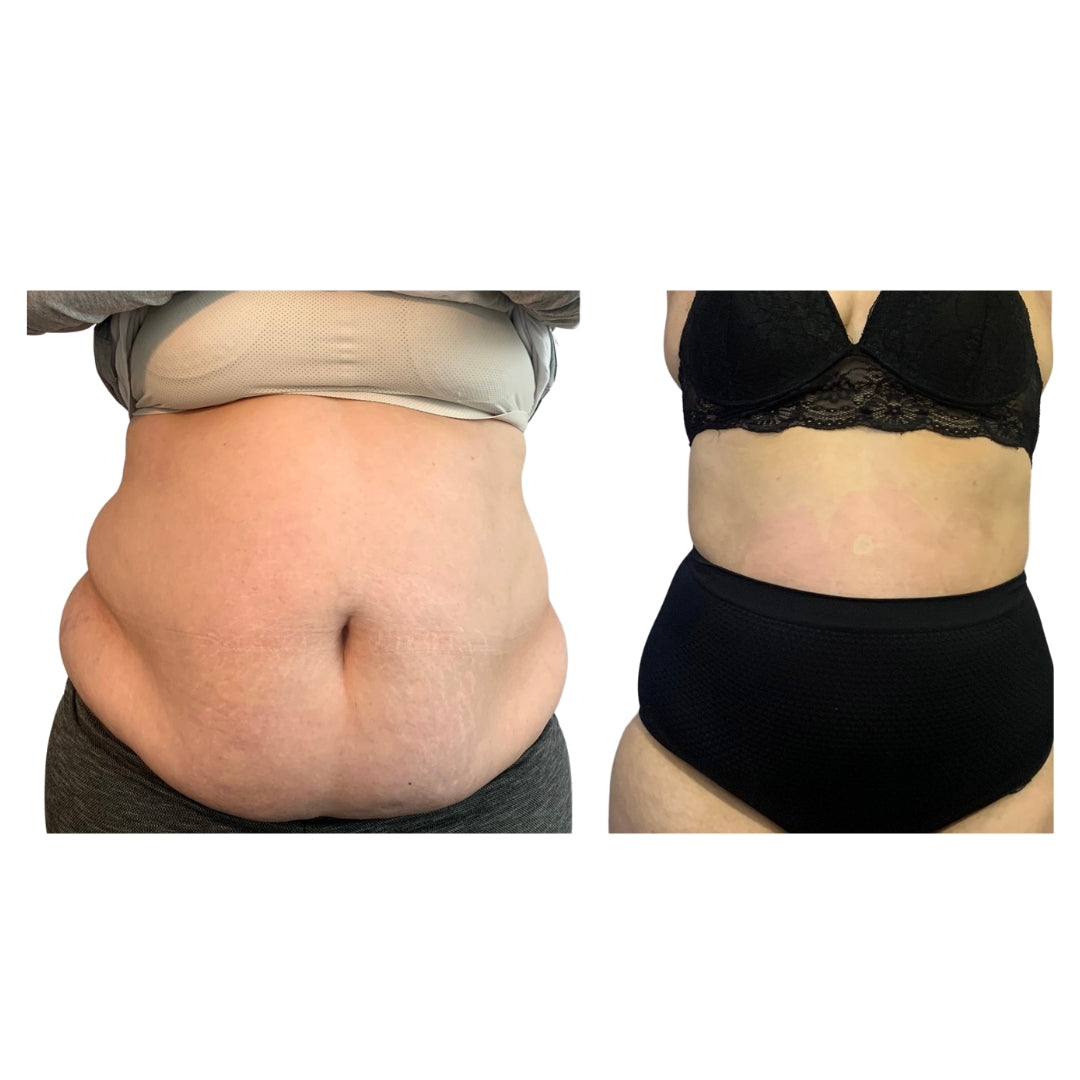 Protocolo Drena-Lifting - Emagrecimento e Flacidez Corporal