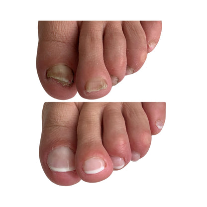 Protocolo Pedicure+Laser Podológico