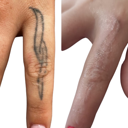 Remoção de Tatuagens e Micropigmentação a Laser