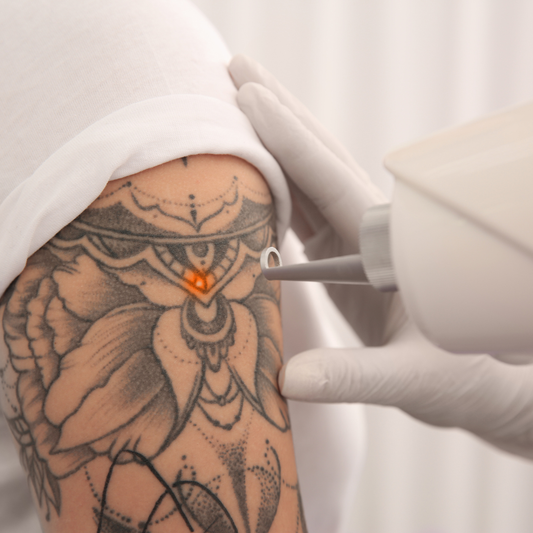 Remoção de Tatuagens e Micropigmentação a Laser