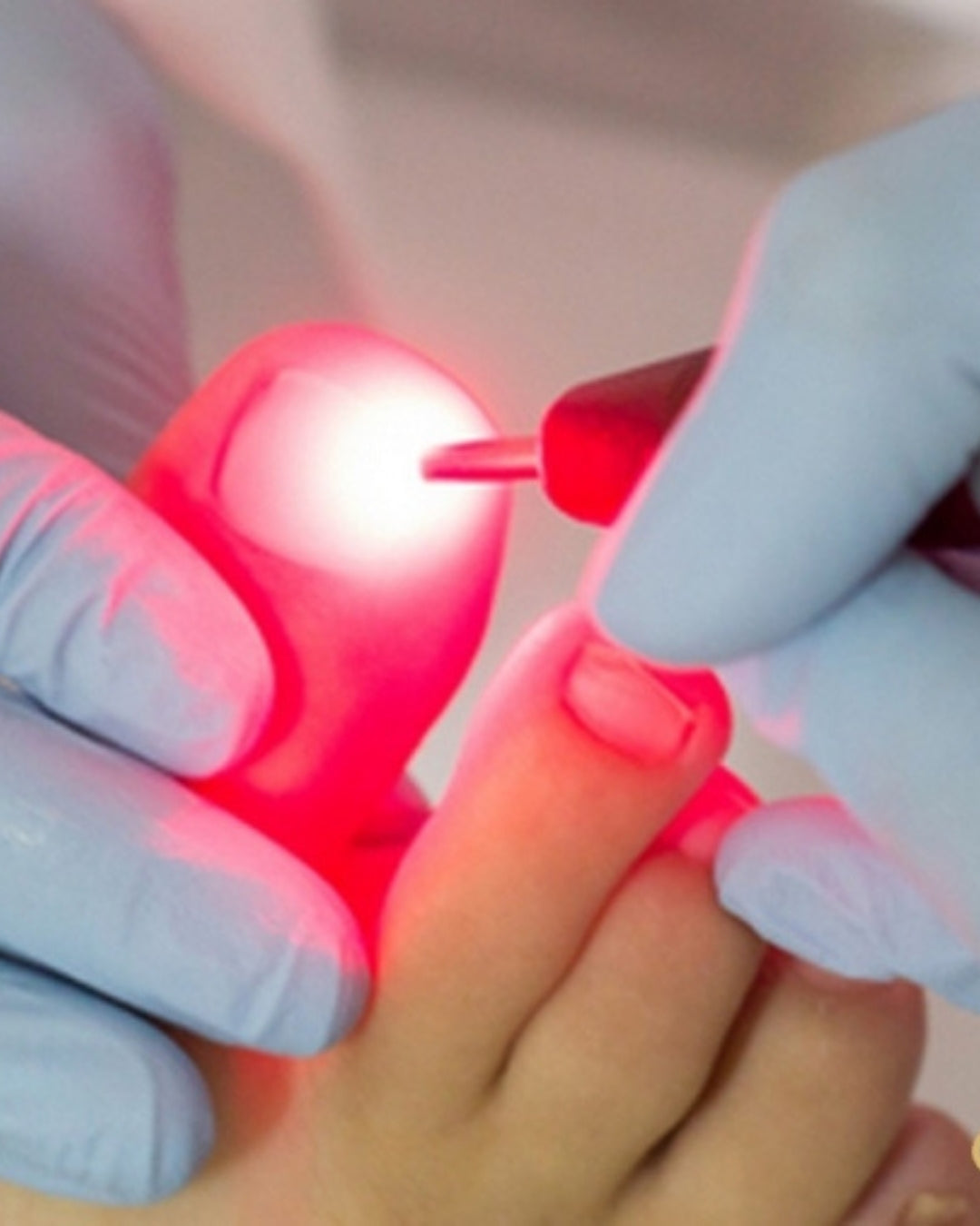 Formação Tratamento de Onicomicose com Laser